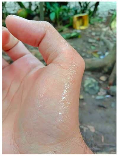 Sweaty hands solution - iontophoresis for feet, soles, palms sweating