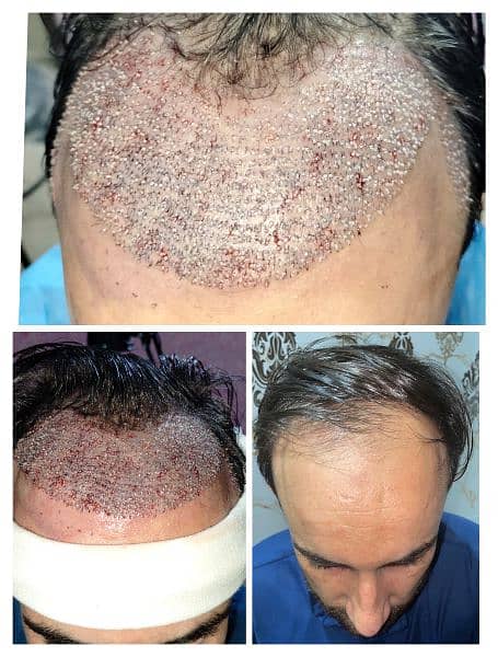 FUE Hair restoration hair units prp 6