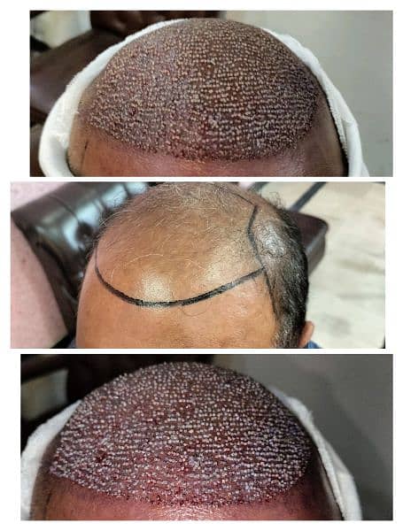 FUE Hair restoration hair units prp 5