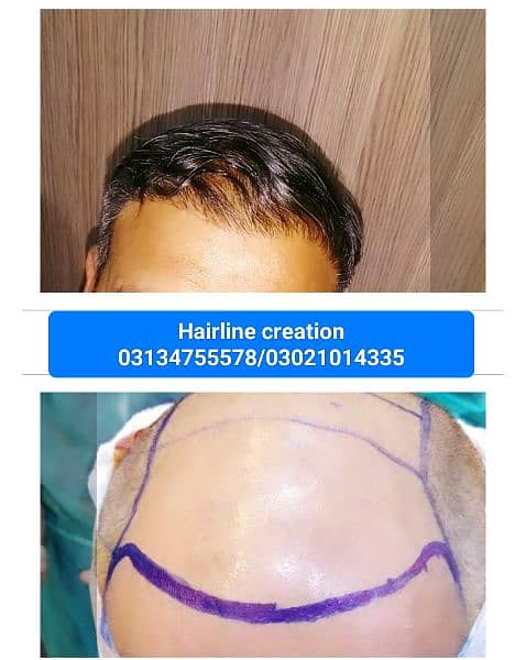 FUE Hair restoration hair units prp 10