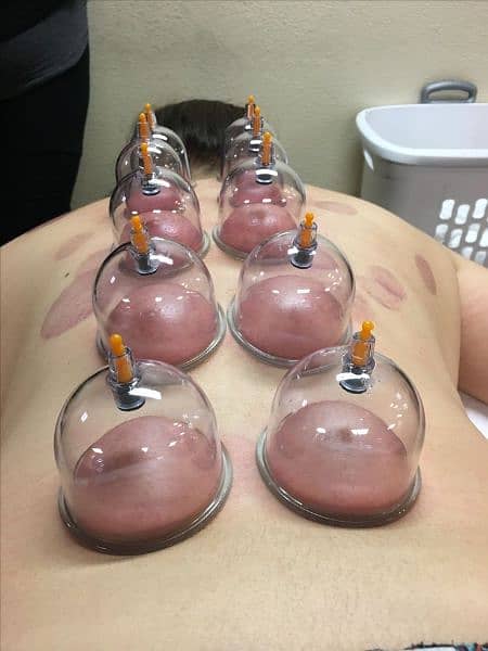 Hijama Cupping Therapy Service 4