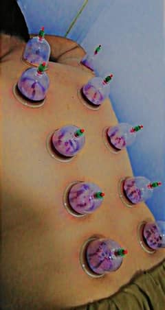 hijama