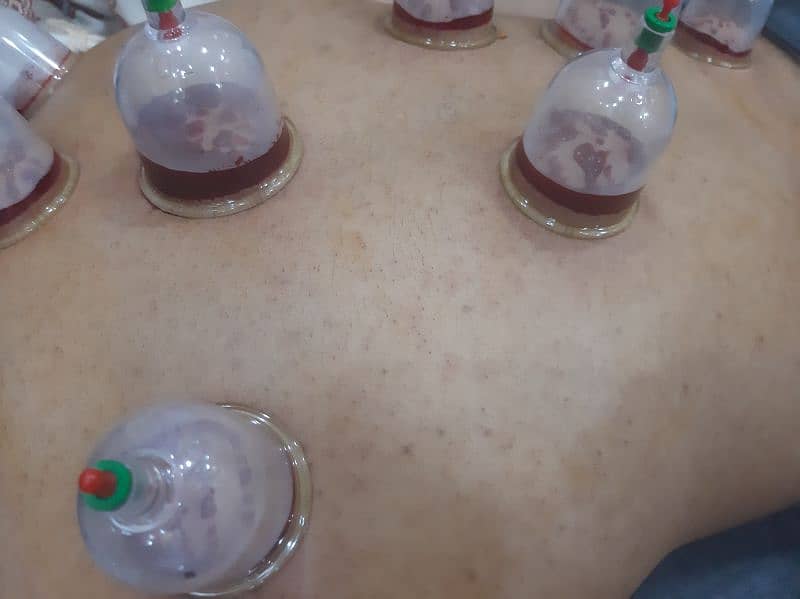 Hijama ( cupping therapy) free home session 1