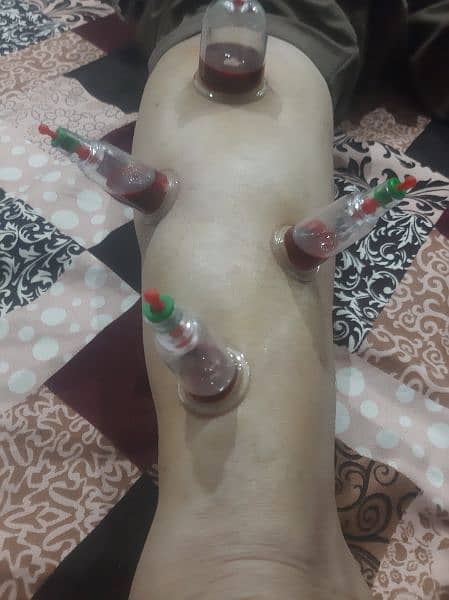 Hijama ( cupping therapy) free home session 3