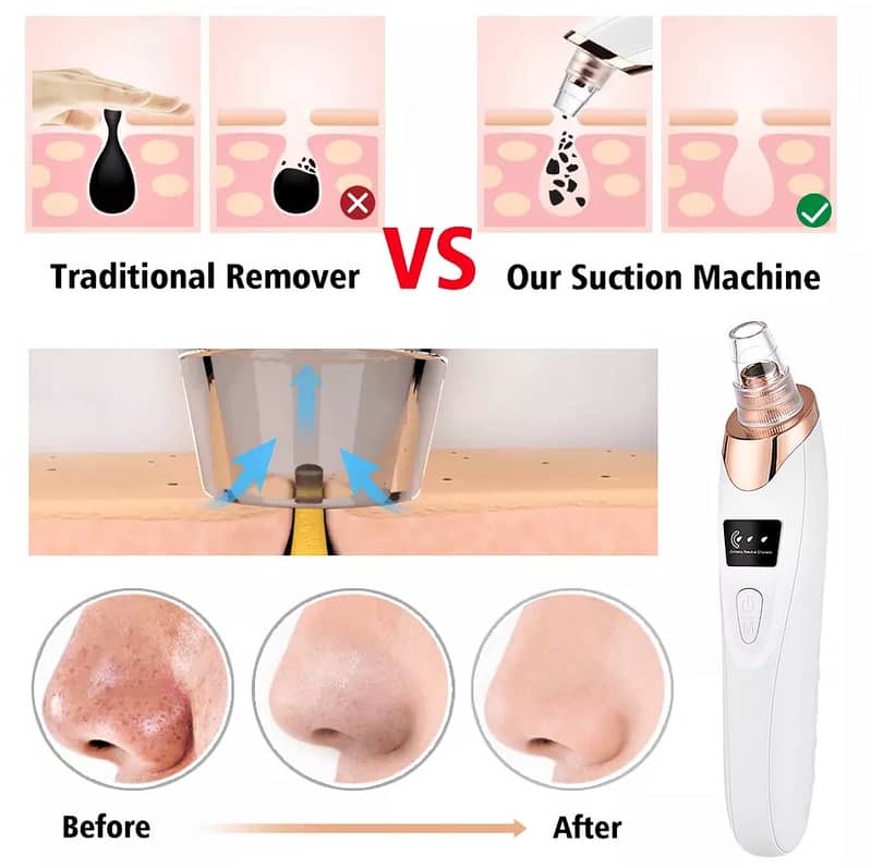 5 in 1 Blackhead Remover Pore Vacuum Electric Facial Cleaner Acne 4