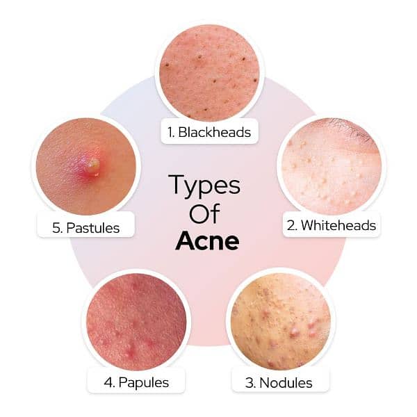 Acne Facewash 0