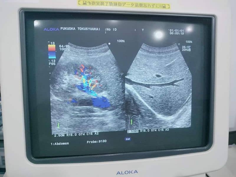 Ultrasound Machines Japani Logiq 500 and Aloka Alpha 10 8
