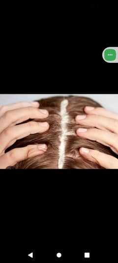 1000%solution Does Scalp Psoriasis Cause Hair Loss