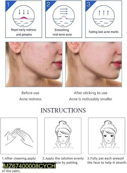 acne-cream 2