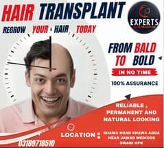Hair transplant