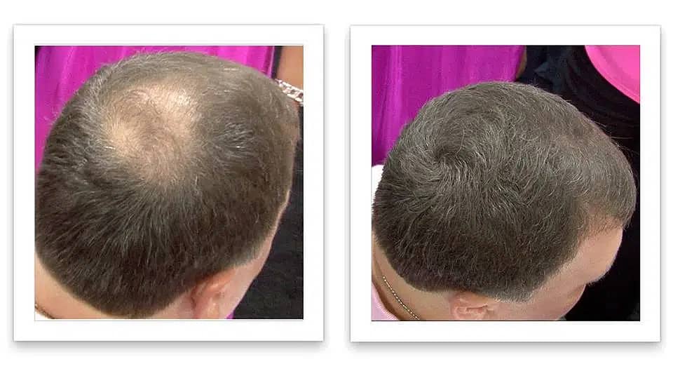 Toppikâ€™s Hair Building Fibers are ideal for concealing hair loss, 15