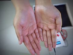 Hyperhidrosis,Sweaty Hands solution. Iontophoresis,iontoderma, dermadry