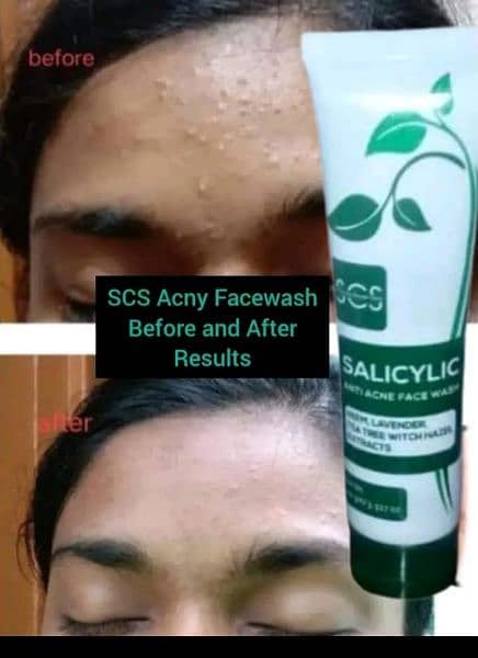 acne face wash 5