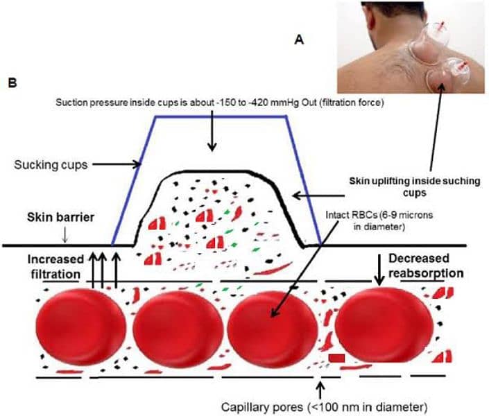 Hijama Cupping Therapy Doctor Hospital Clinic Skin Gym    Home Service 3