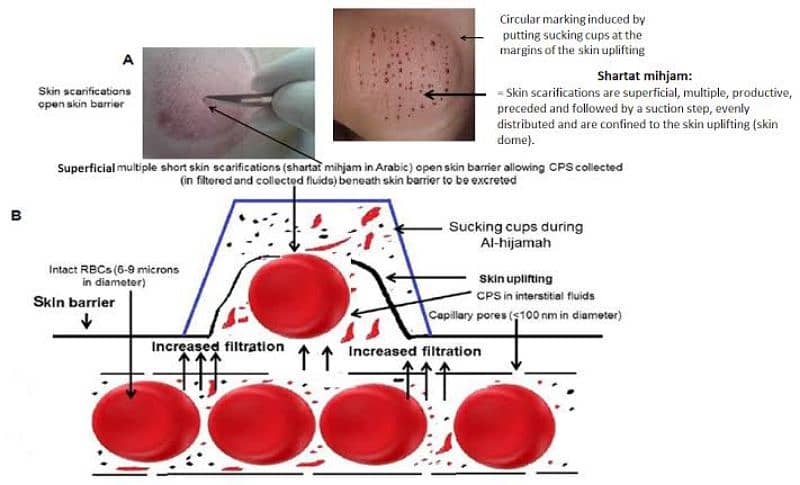 Hijama Cupping Therapy Doctor Hospital Clinic Skin Gym    Home Service 4