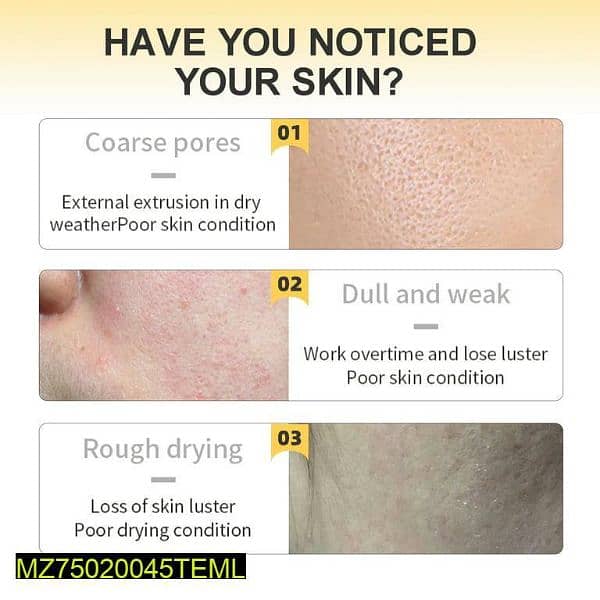 Acne-prone skin 3