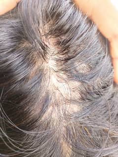 Best serum and oil for alopecia,balchar and hairgrowth