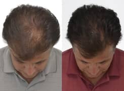 Hair Growth igrow System