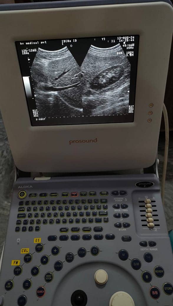 Refurb japanese grayscale ultrasound machine toshiba aloka 10