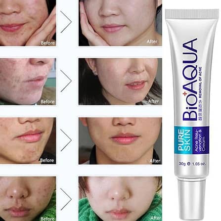 Acne Scar Removal Rejuvenation Cream, 30ml 1