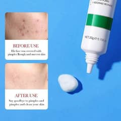 ACNE AND PIMPLES REMOVAL CREAM