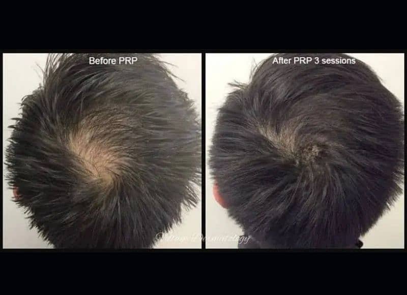 Hair PRP , Face PRP, Microneedling 0