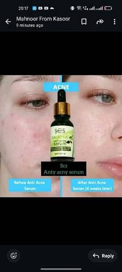 anti ACNE serum