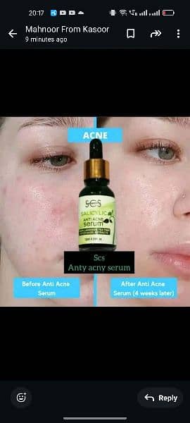 anti ACNE serum 0