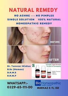 Face Pimples & Acne Solution        One Month Course