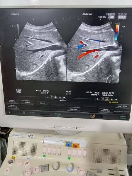 Ultrasound machine color Doppler and gray scale 9