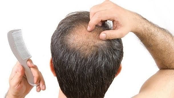 THE TREATMENT OF BALDNESS MAKES YOUR HAIR LONG. STRONG DARK & SILKY. . 3