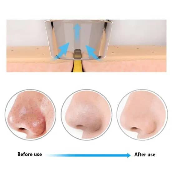 5 In 1 Electric Blackhead Acne Oil Remover Vacuum Suction Face Pore C 1