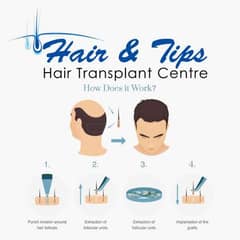 Hair Transplant