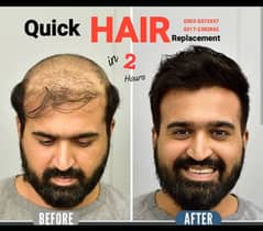 Hair wigs hair unit hair patch sale in Karachi.