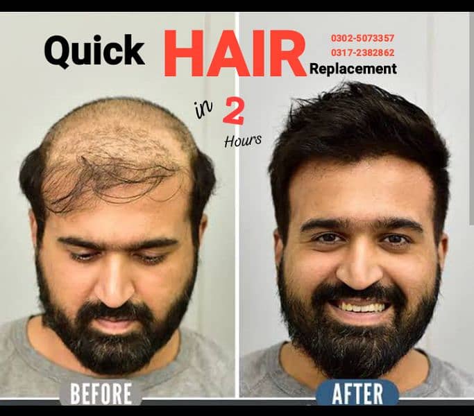 Hair wigs hair unit hair patch sale in Karachi. 0