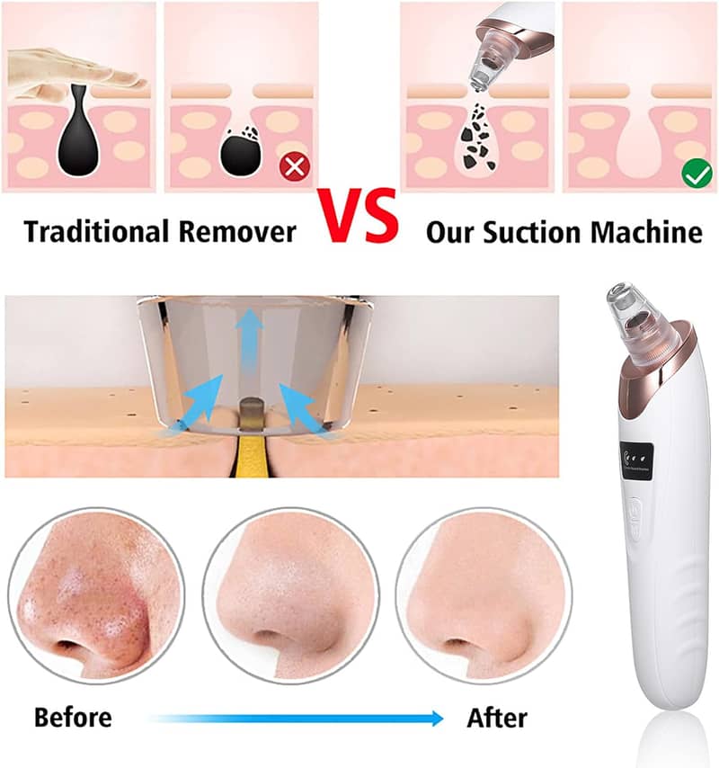 Blackhead Remover Electric 5 in1 Blackhead Suction Device,Cleaner Kit 1