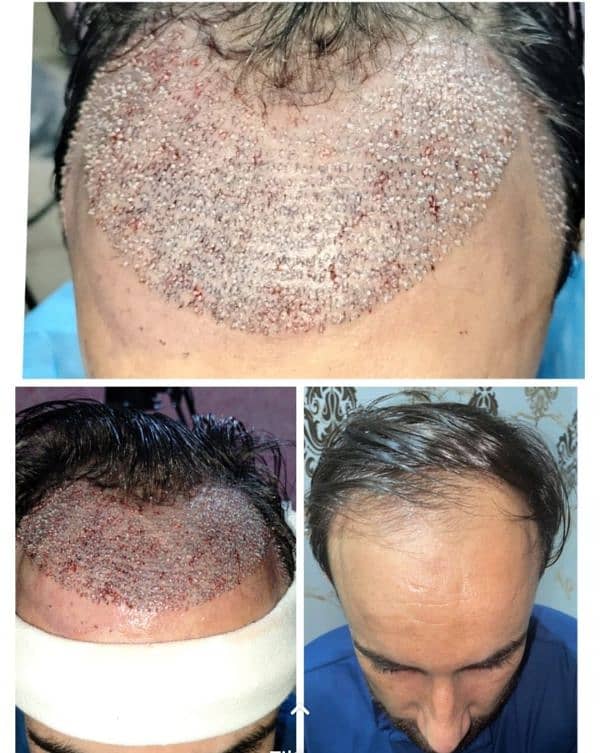 FUE hair transplant hair pieces wigs 4