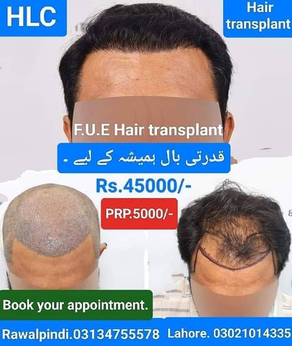 FUE hair transplant hair pieces wigs 5