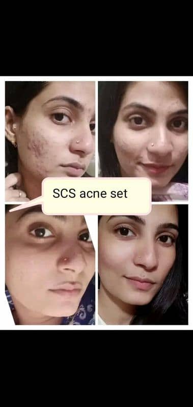 Skin care acne treatment mask 1