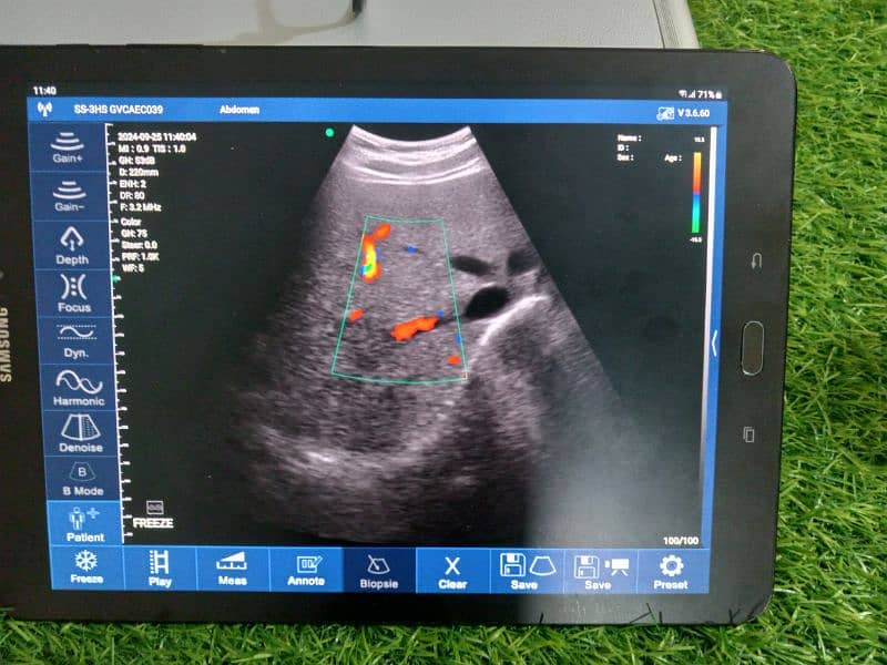 Ultrasound Color Doppler Wireless Probe 5