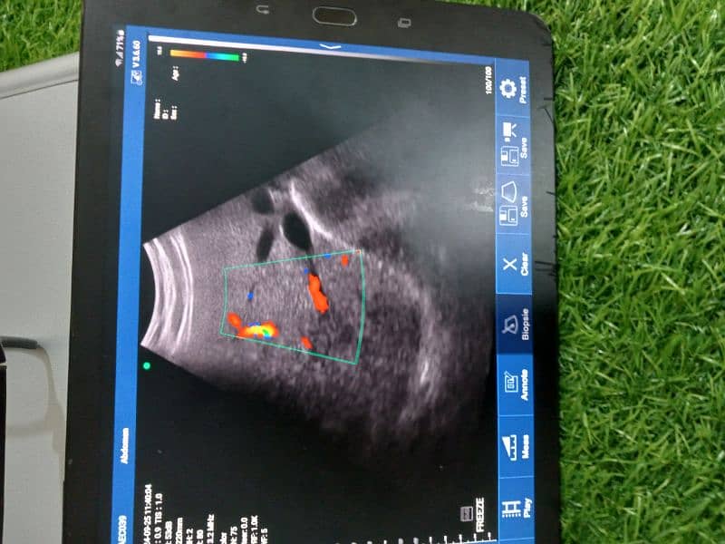 Ultrasound Color Doppler Wireless Probe 6