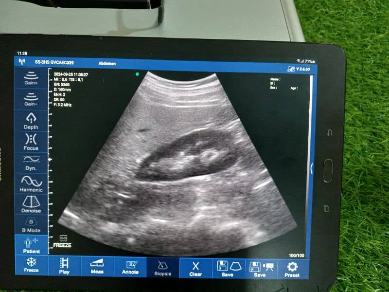 Ultrasound Color Doppler Wireless Probe 7