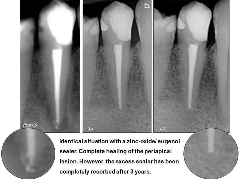 BDS,RDS, implantlogest 0