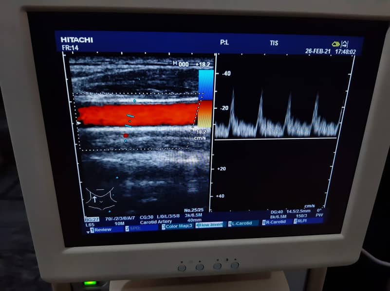 HITACHI EUB-7000 ULTRASOUND DOPPLER ECHOCARDIOGRAPHY MACHINE 0