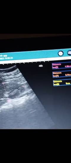 Ultrasound