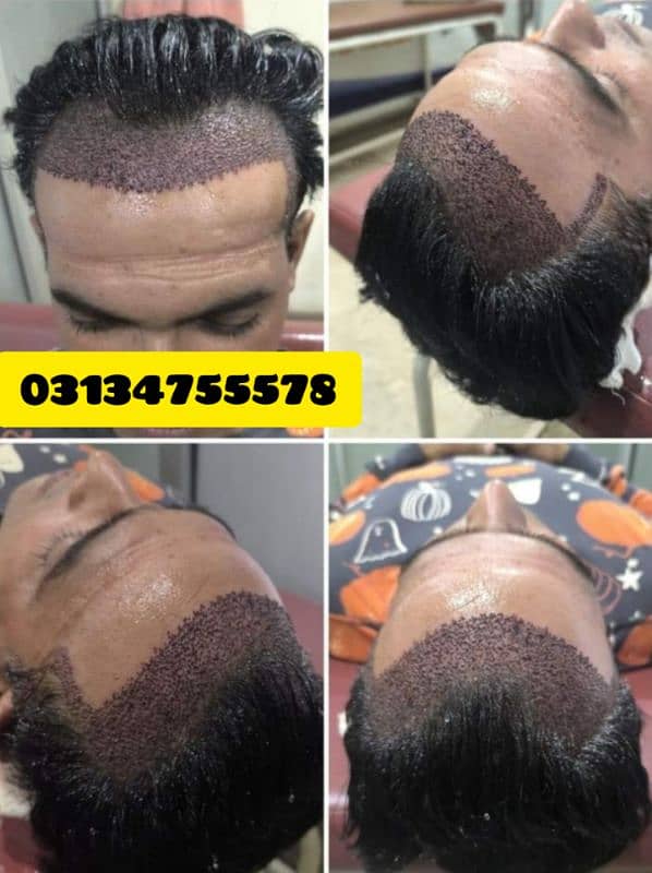 FUE Hair Transplant Hair units 2