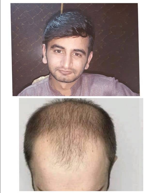 FUE Hair Transplant Hair units 3