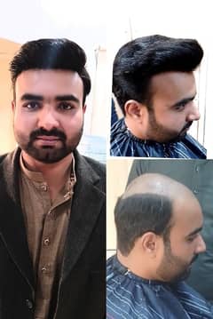 hair units hair transplant services PRP