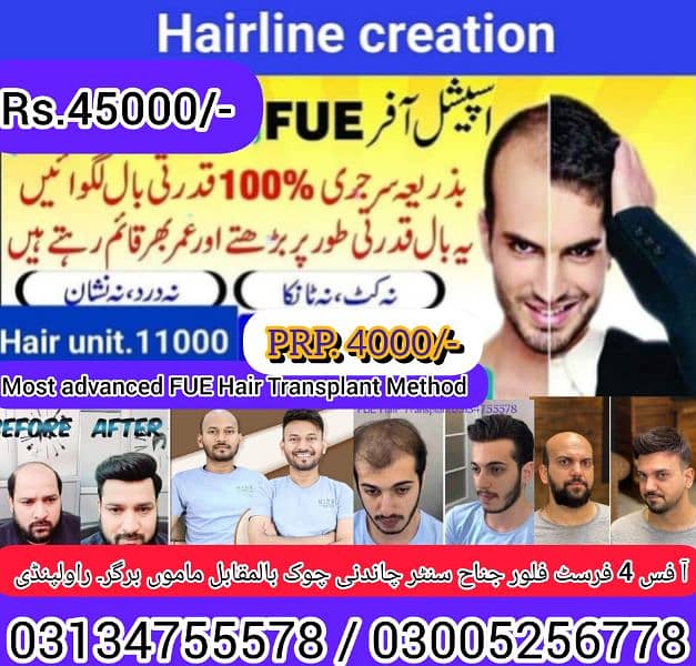 hair units hair transplant services PRP 2