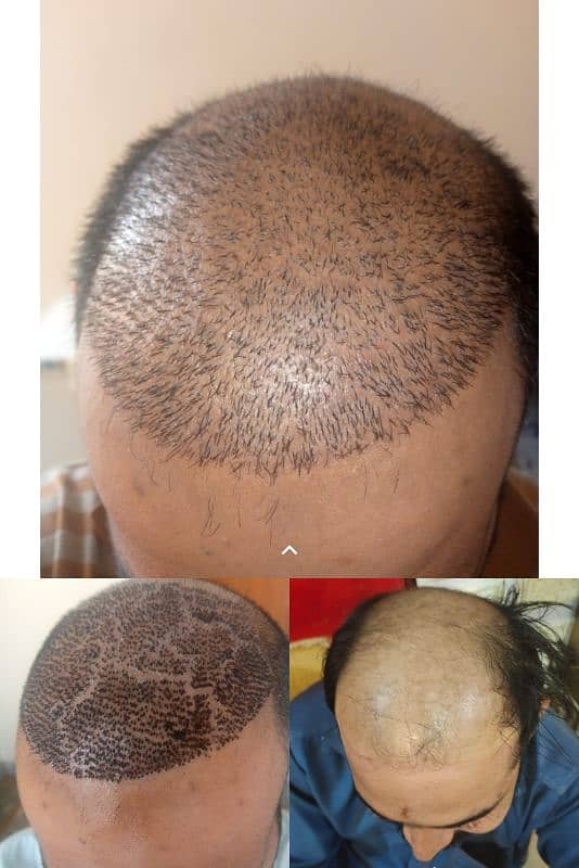 hair units hair transplant services PRP 3